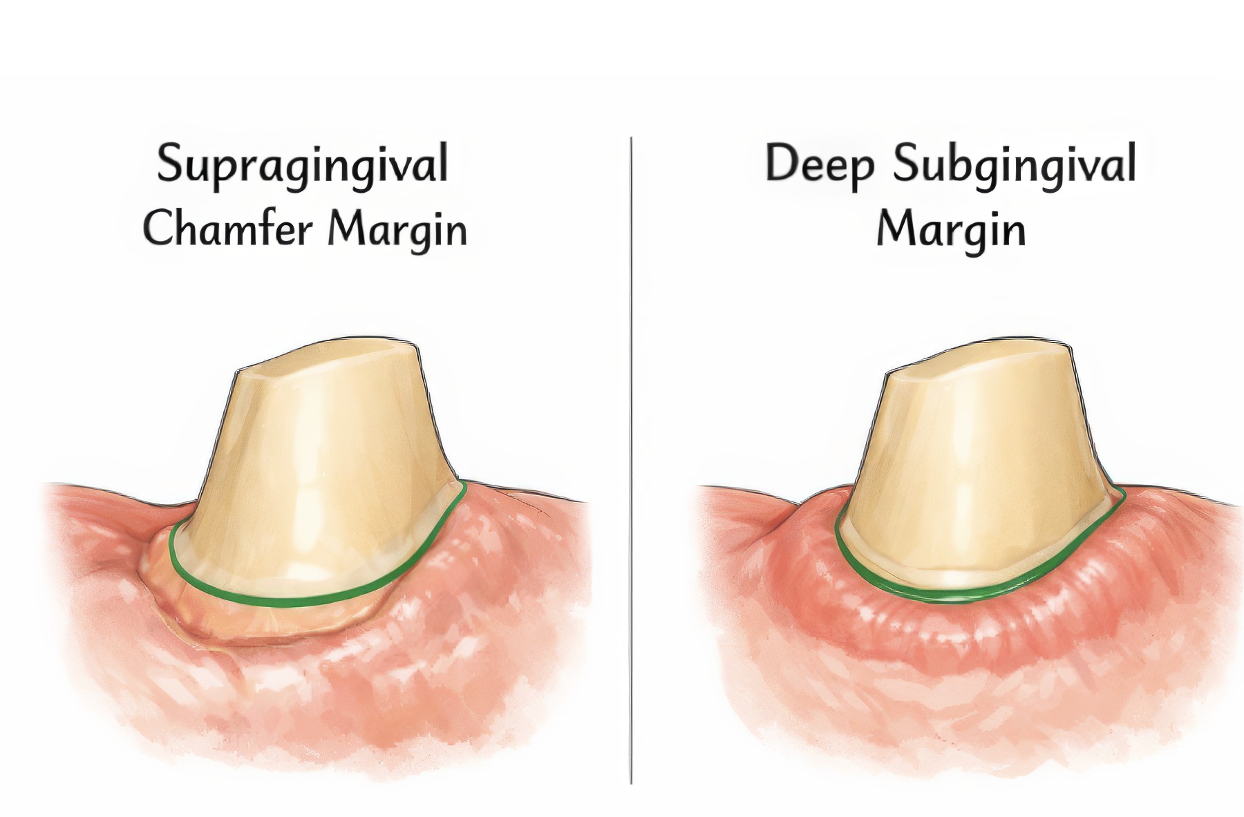 How To Capture Accurate Crown Margins with An Intraoral Scanner | by Andrew Sedler | Burbank Dental Lab