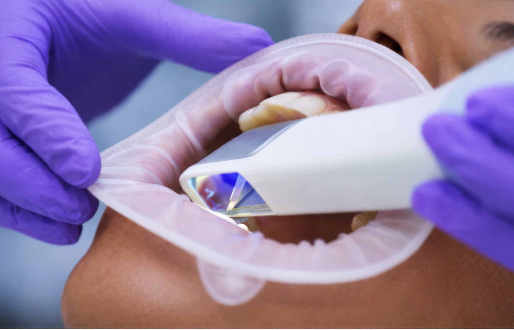 How to Ensure Accurate Crown Margin Capture with an Intraoral Scanner | by Andrew Sedler | Burbank Dental Lab