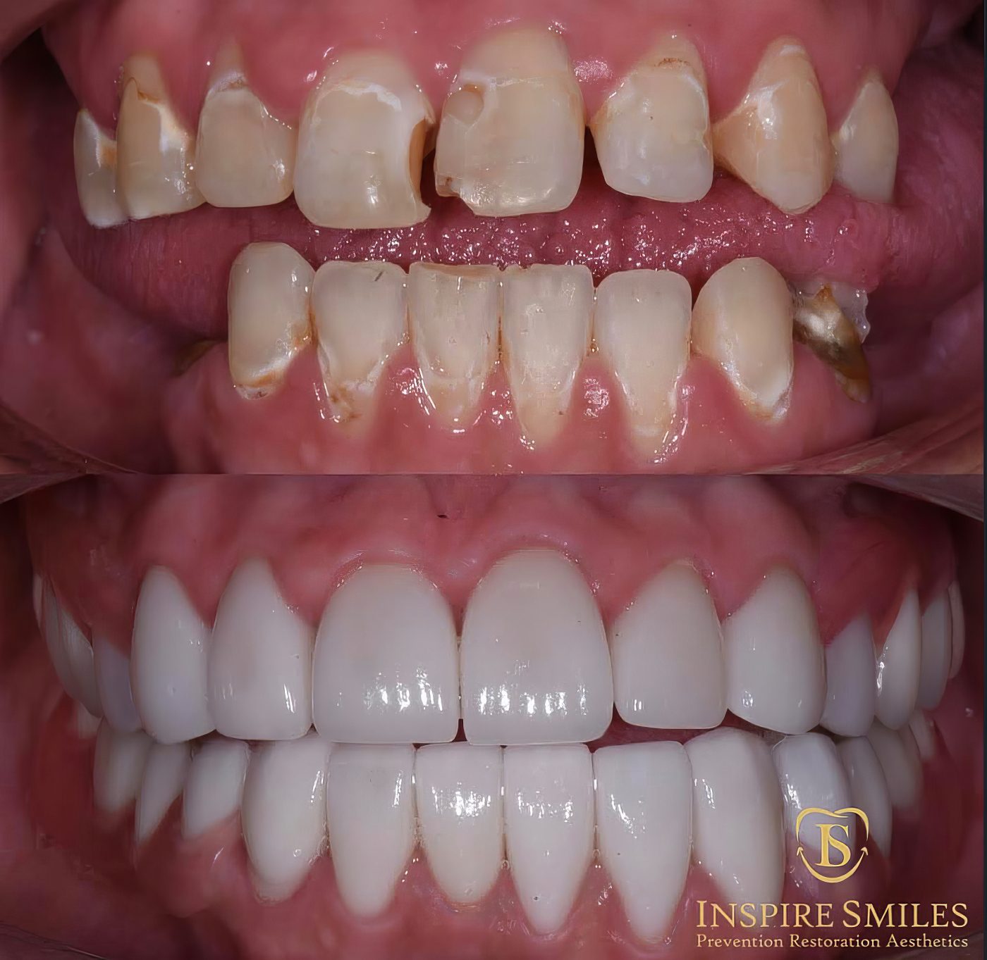 The Life-Changing Impact of Compassionate Dental Care - Cassondra's Smile Transformation - Dr. Elona Gaball through the Alabaster Jar Project - Compassionate Dentistry - Burbank Dental Lab