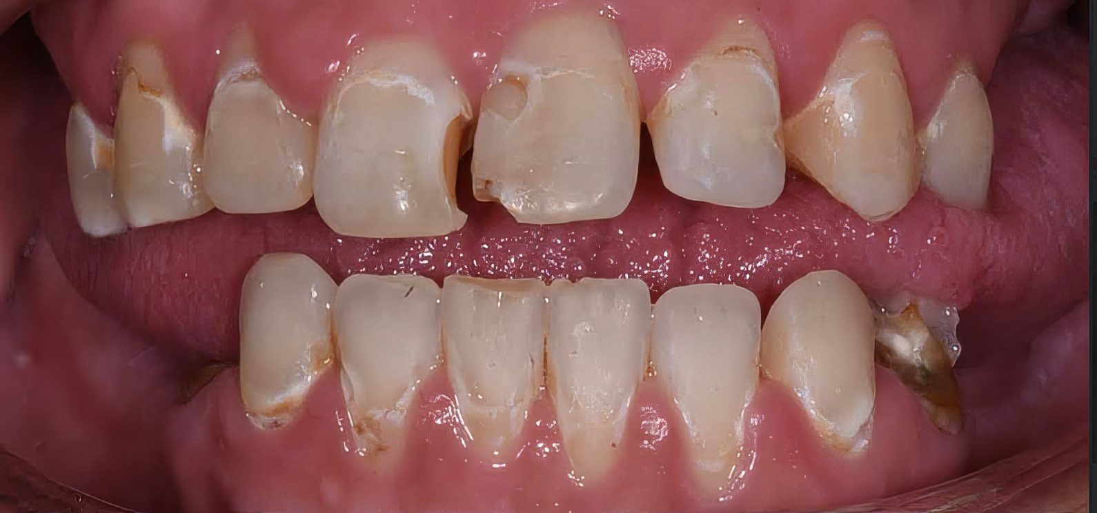 The Life-Changing Impact of Compassionate Dental Care - Cassondra's Smile Transformation - Dr. Elona Gaball through the Alabaster Jar Project - Compassionate Dentistry - Burbank Dental Lab