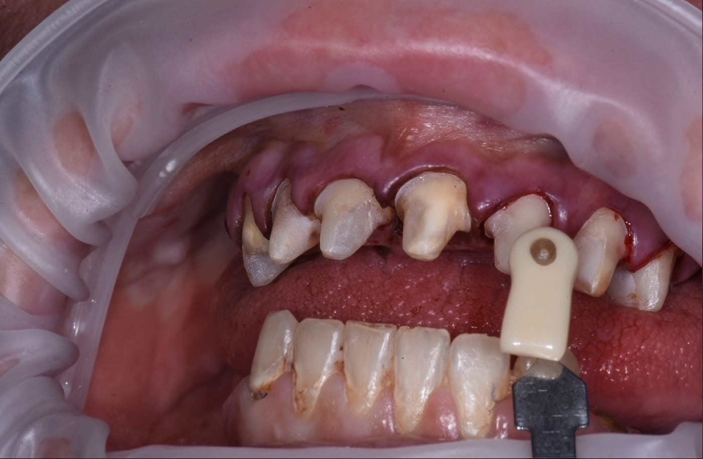 The Life-Changing Impact of Compassionate Dental Care - Cassondra's Smile Transformation - Dr. Elona Gaball through the Alabaster Jar Project - Compassionate Dentistry - Burbank Dental Lab