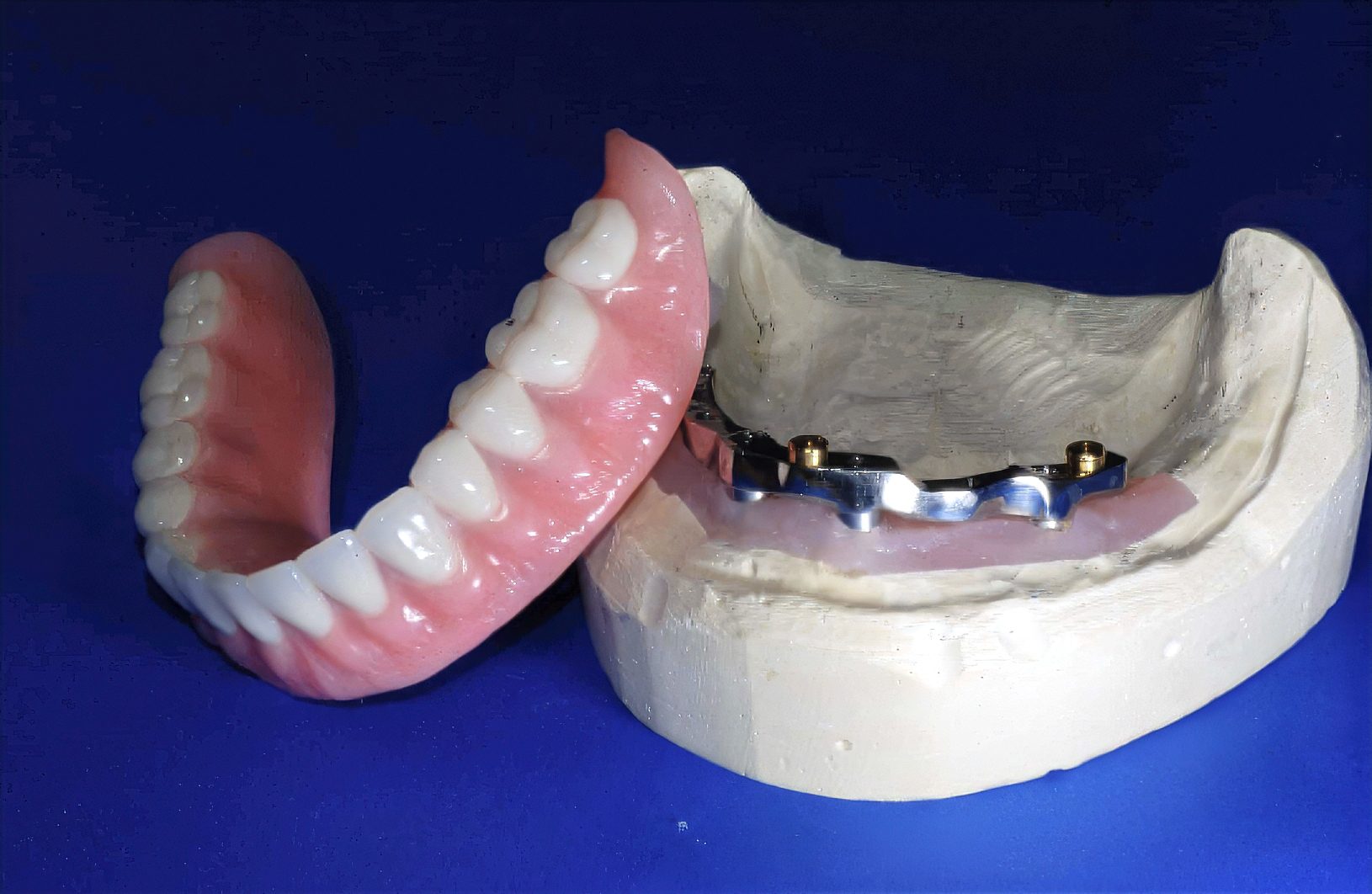 Choosing the Right Full-Arch Implant Restoration: Hybrid, Zirconia or Acrylic - by Andrew Sedler - Burbank Dental Lab - CA