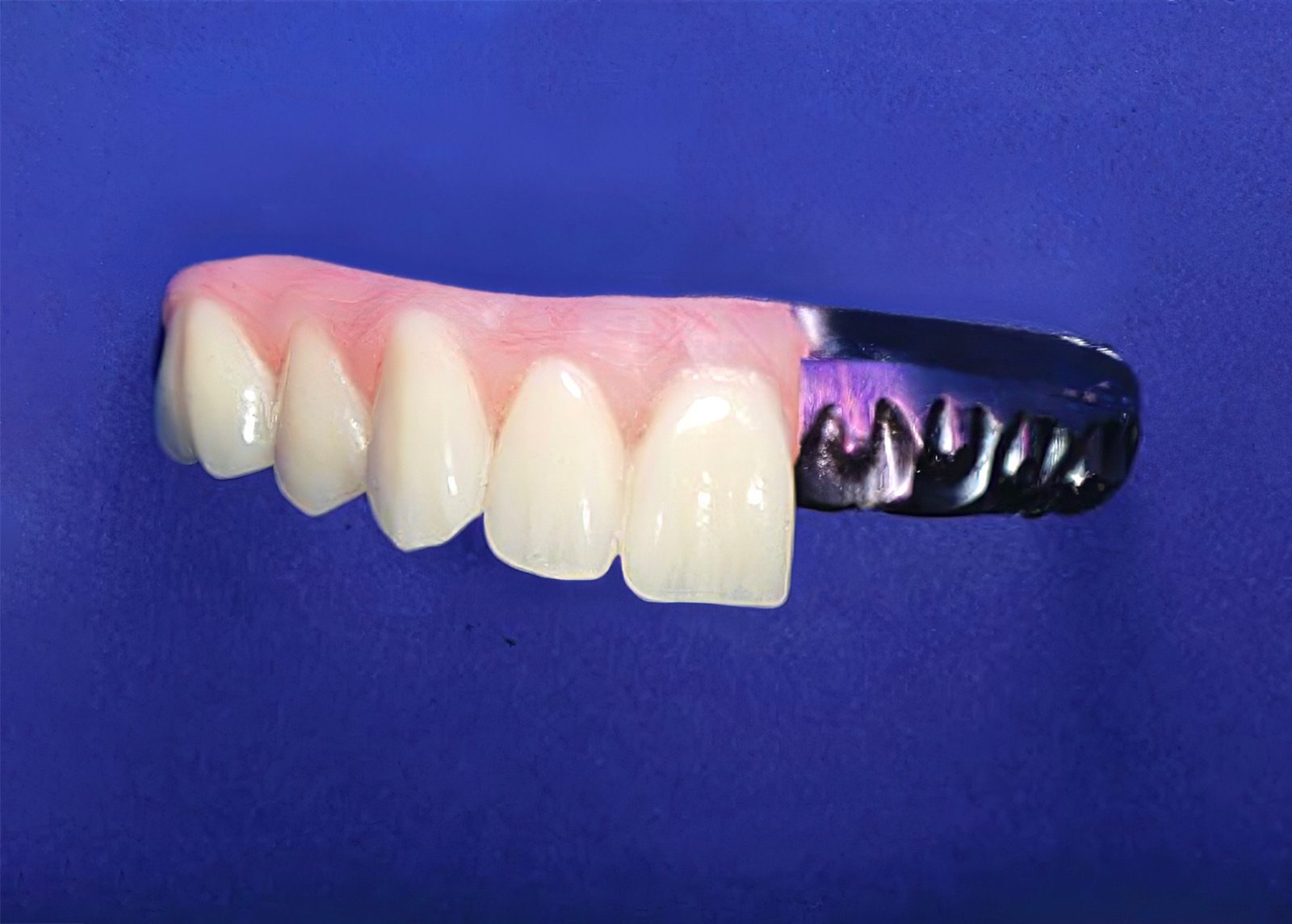 Choosing the Right Full-Arch Implant Restoration: Hybrid, Zirconia or Acrylic - by Andrew Sedler - Burbank Dental Lab - CA