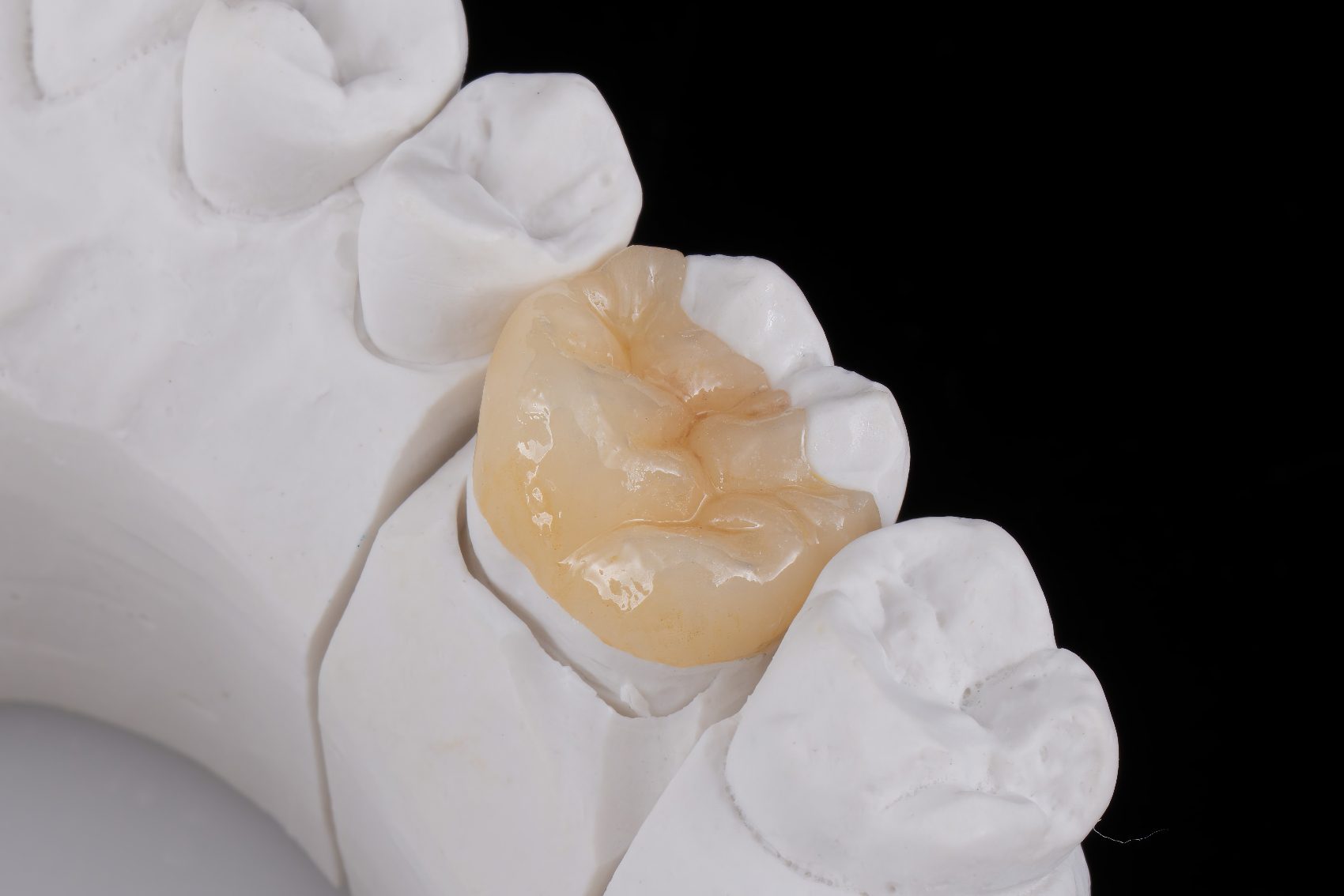 Classic Feldspathic Porcelain Veneers