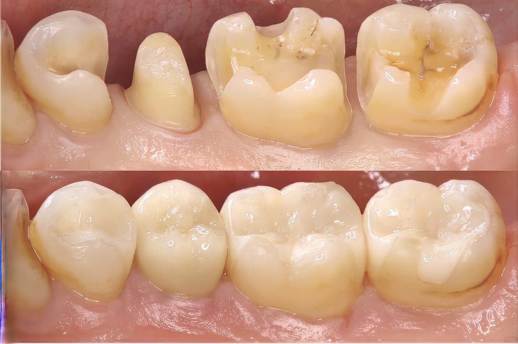 Feldspathic Porcelain Veneers - Burbank Dental Lab - CA