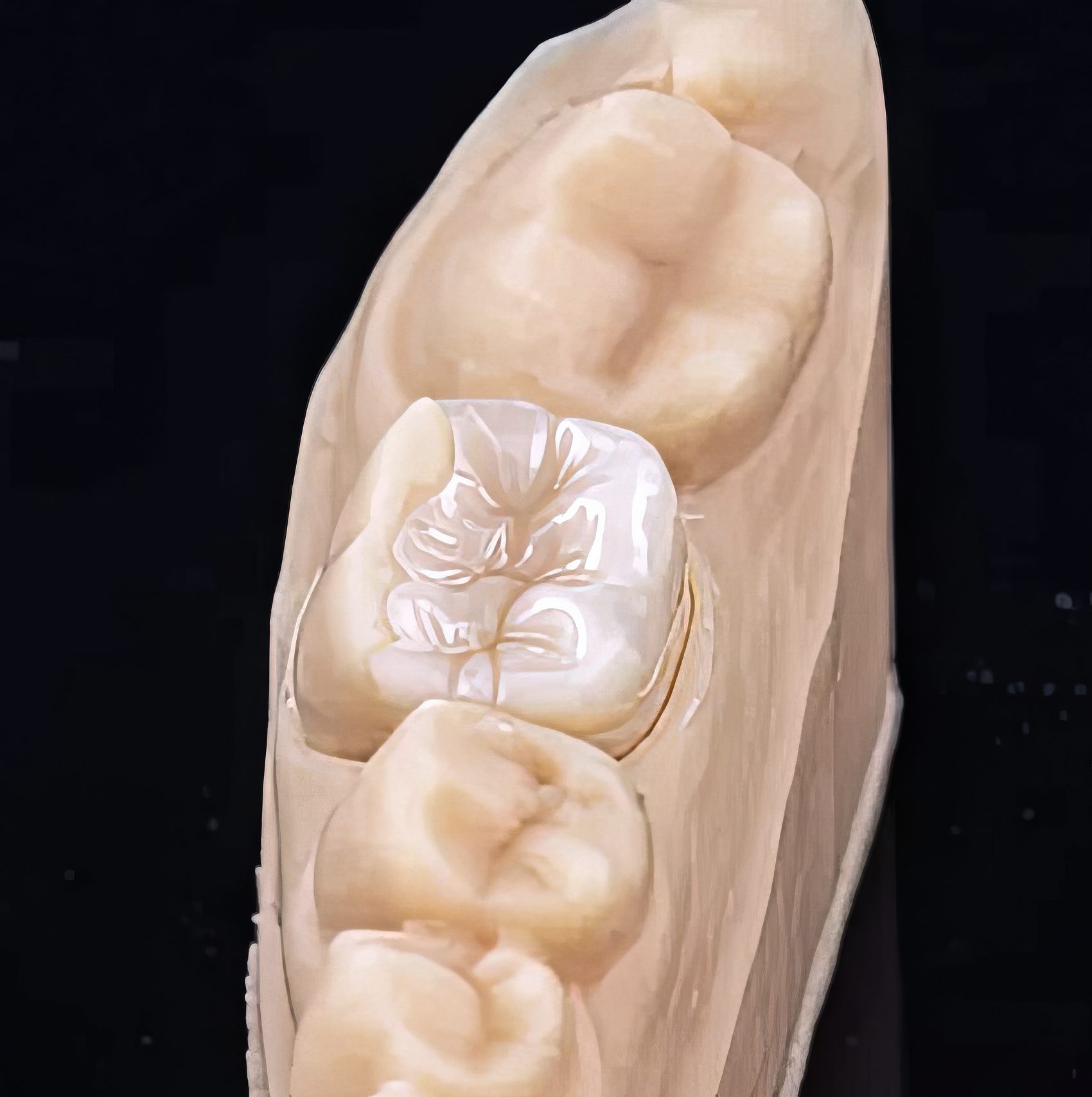 Classic Feldspathic Porcelain Veneers