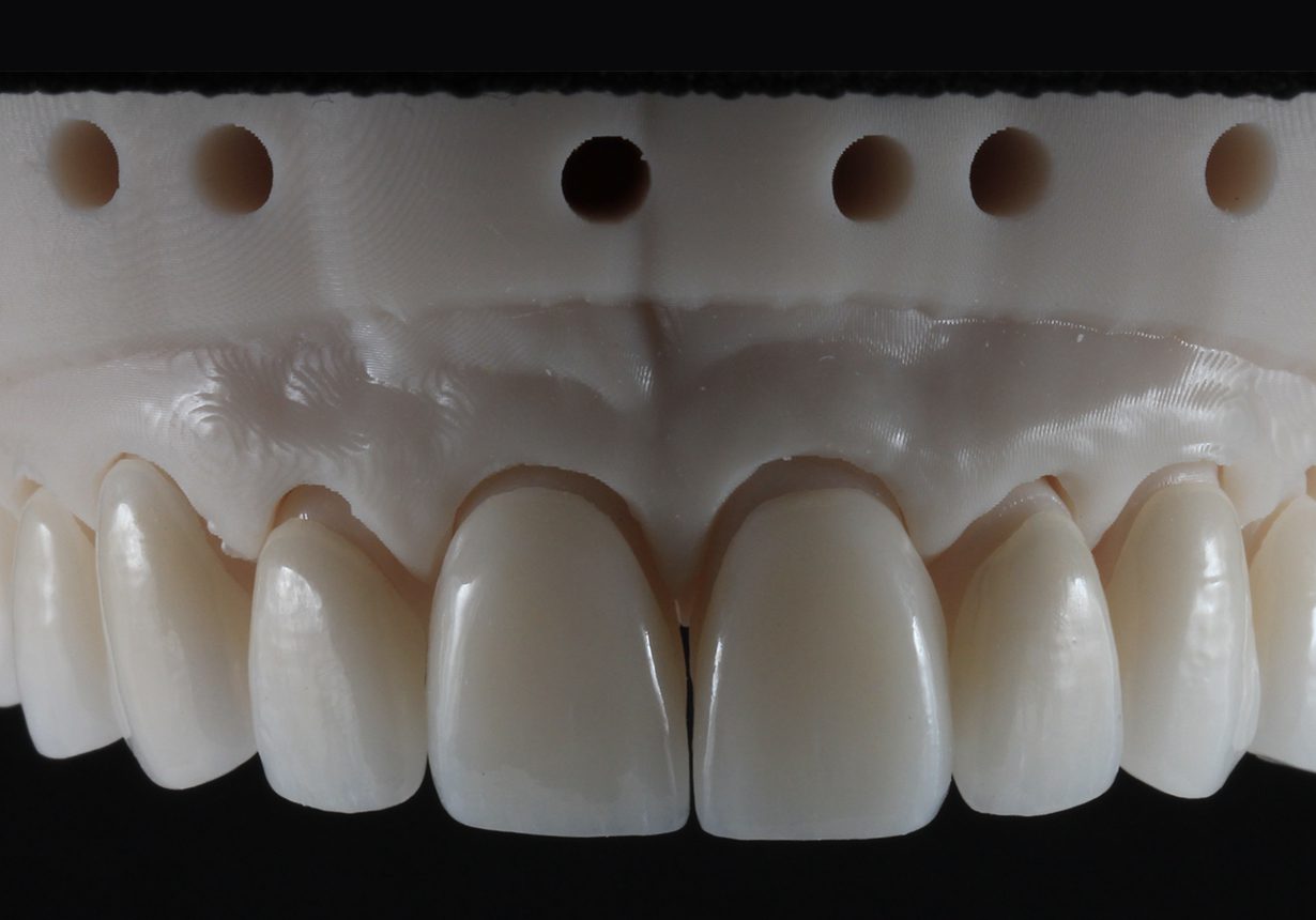 The Predictability Path: Biomimetic Principles for Veneers - Burbank Dental Lab