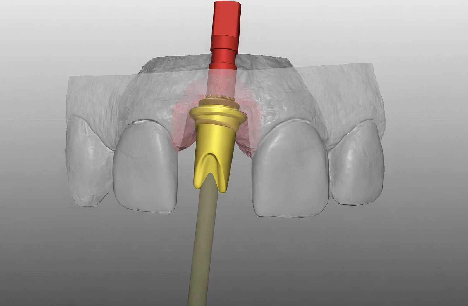 Implant Immediate Load: A Clinical Evaluation - ZIRMAX - SMART 1