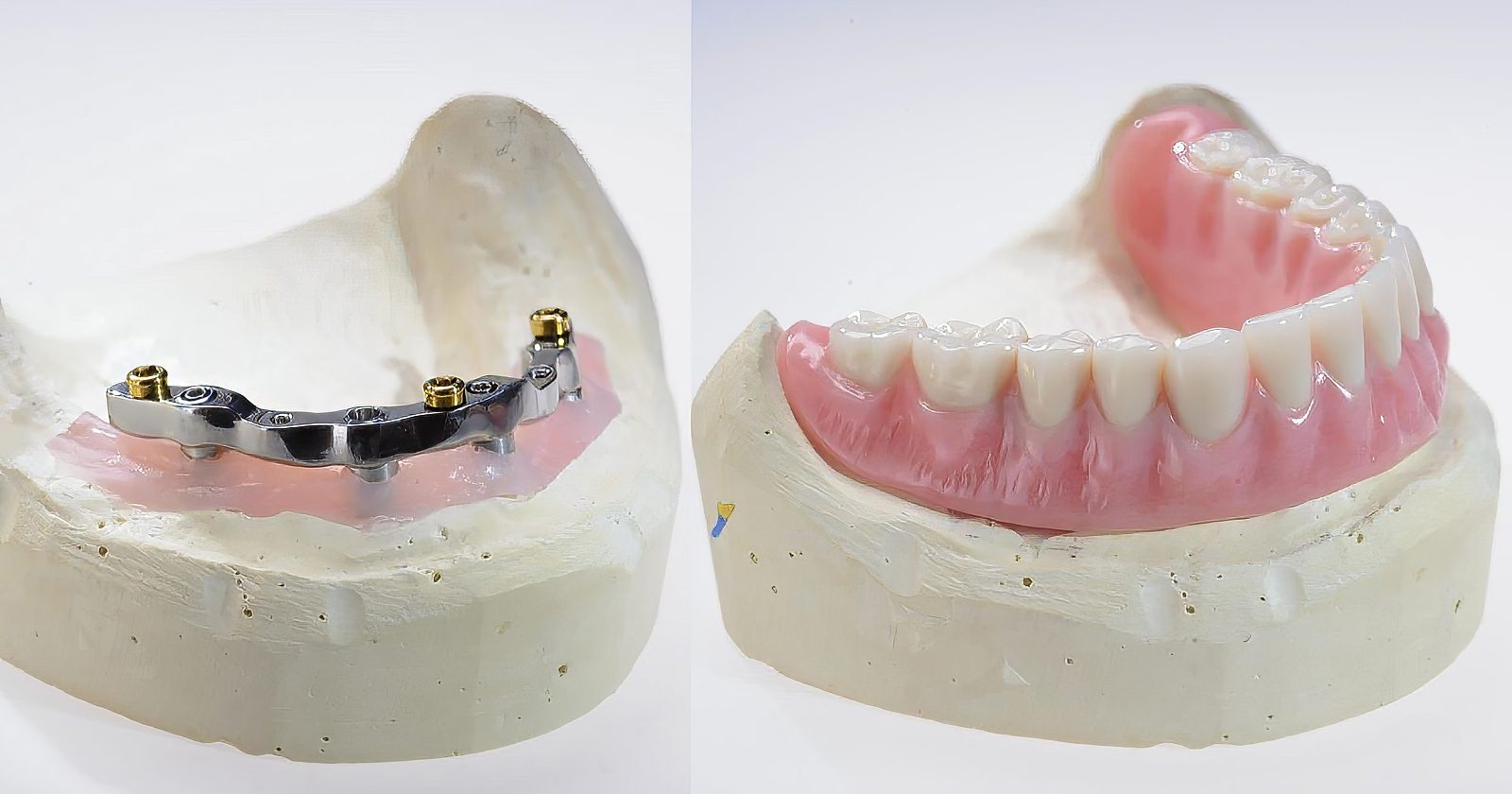 Denture Over Implant Bars - Burbank Dental Lab
