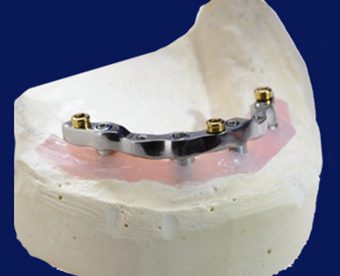 SMART 1 Implant Abutments - Burbank Dental Lab