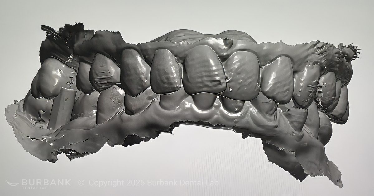 Diagnostic Wax-Up - Digital Scan - Bite Registration