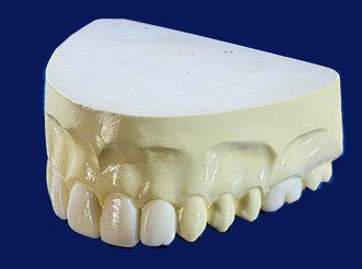 Diagnostic Wax-ups, A Burbank Dental Lab product in our Esthetic All-Ceramic category of Products - Burbank Dental Lab - CA