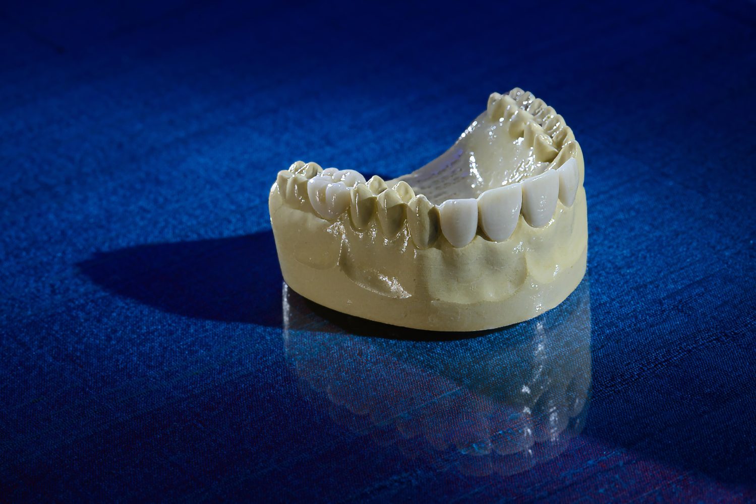 Diagnostic Wax-ups, A Burbank Dental Lab product in our Esthetic All-Ceramic category of Products - Burbank Dental Lab - CA