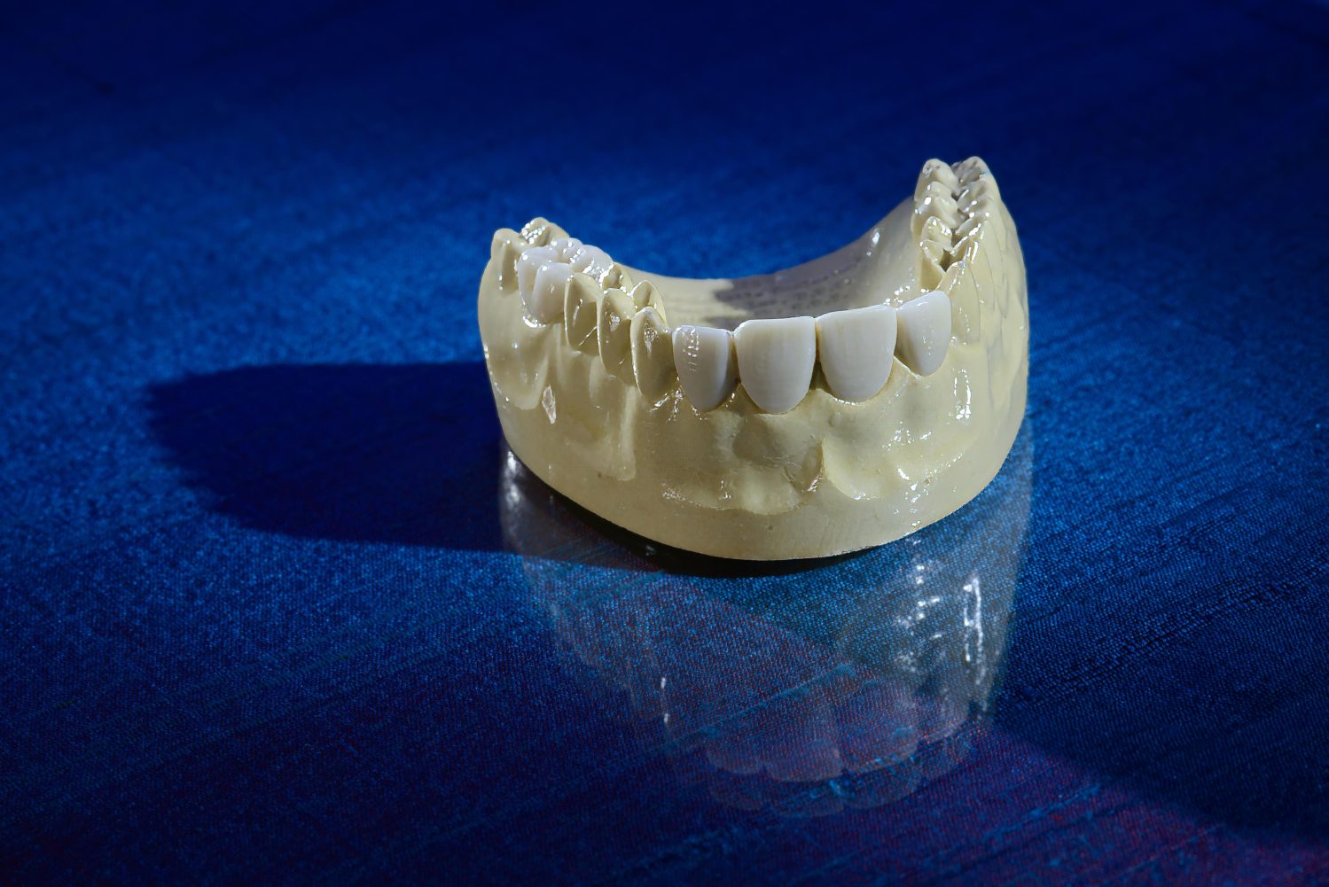 Diagnostic Wax-ups, A Burbank Dental Lab product in our Esthetic All-Ceramic category of Products - Burbank Dental Lab - CA