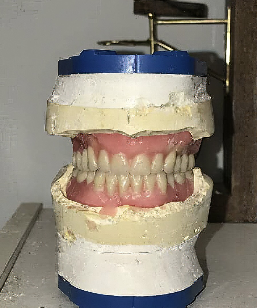 Step-By-Step Digital Workflow for Edentulous Implant Cases | Burbank Dental Lab