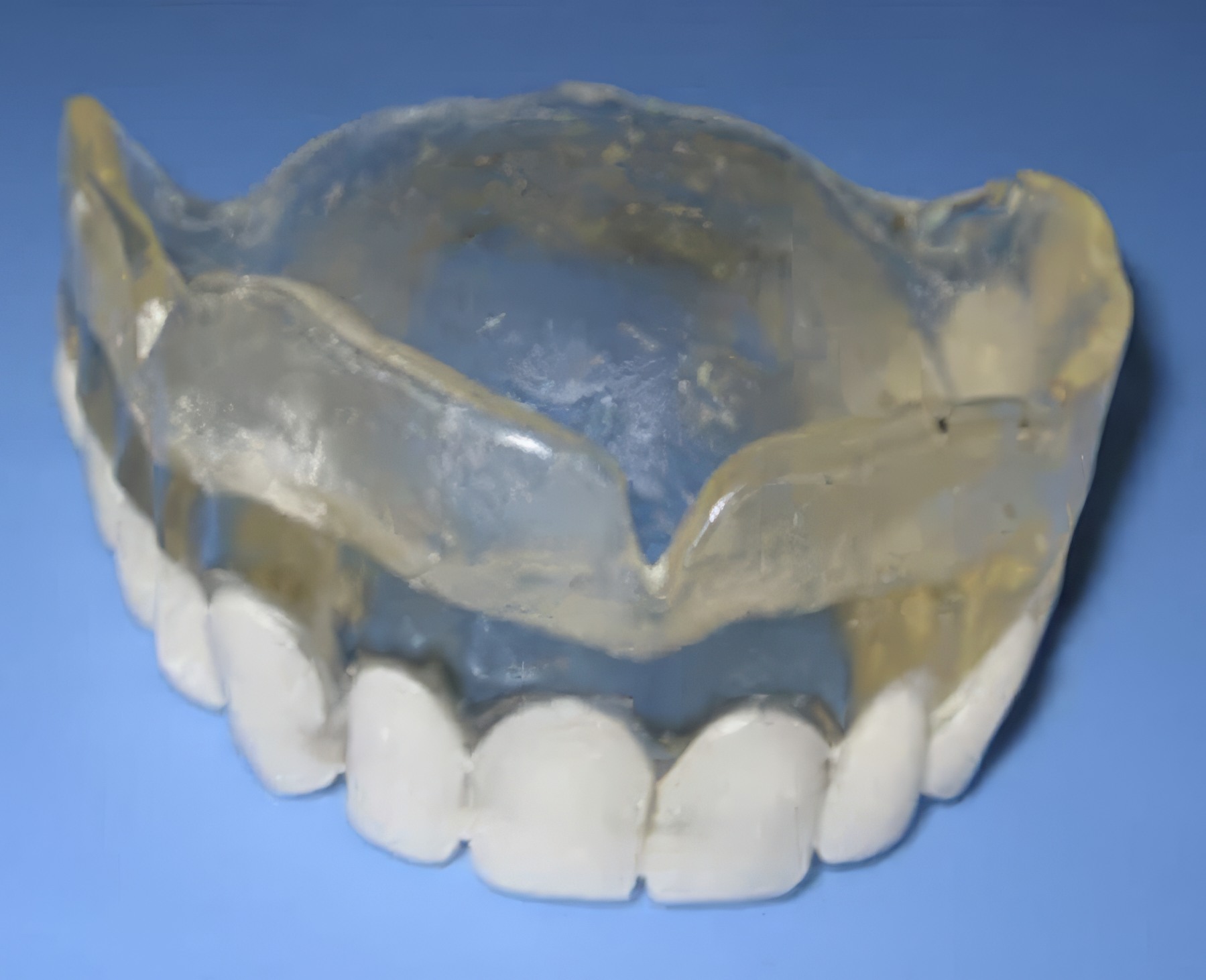 Step-By-Step Digital Workflow for Edentulous Implant Cases | Burbank Dental Lab