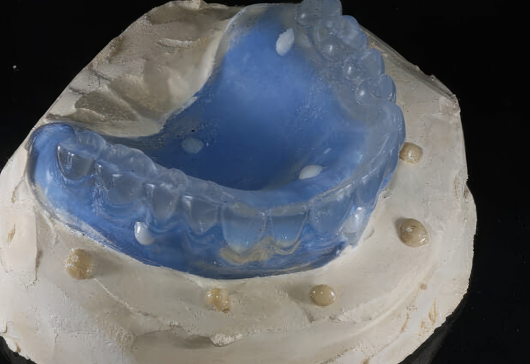 Step-By-Step Digital Workflow for Edentulous Implant Cases | Burbank Dental Lab