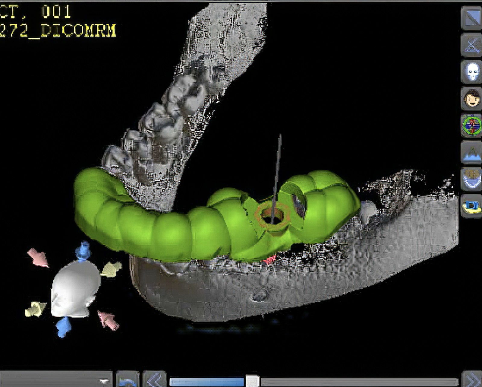 Step-By-Step Digital Workflow for Edentulous Implant Cases | Burbank Dental Lab