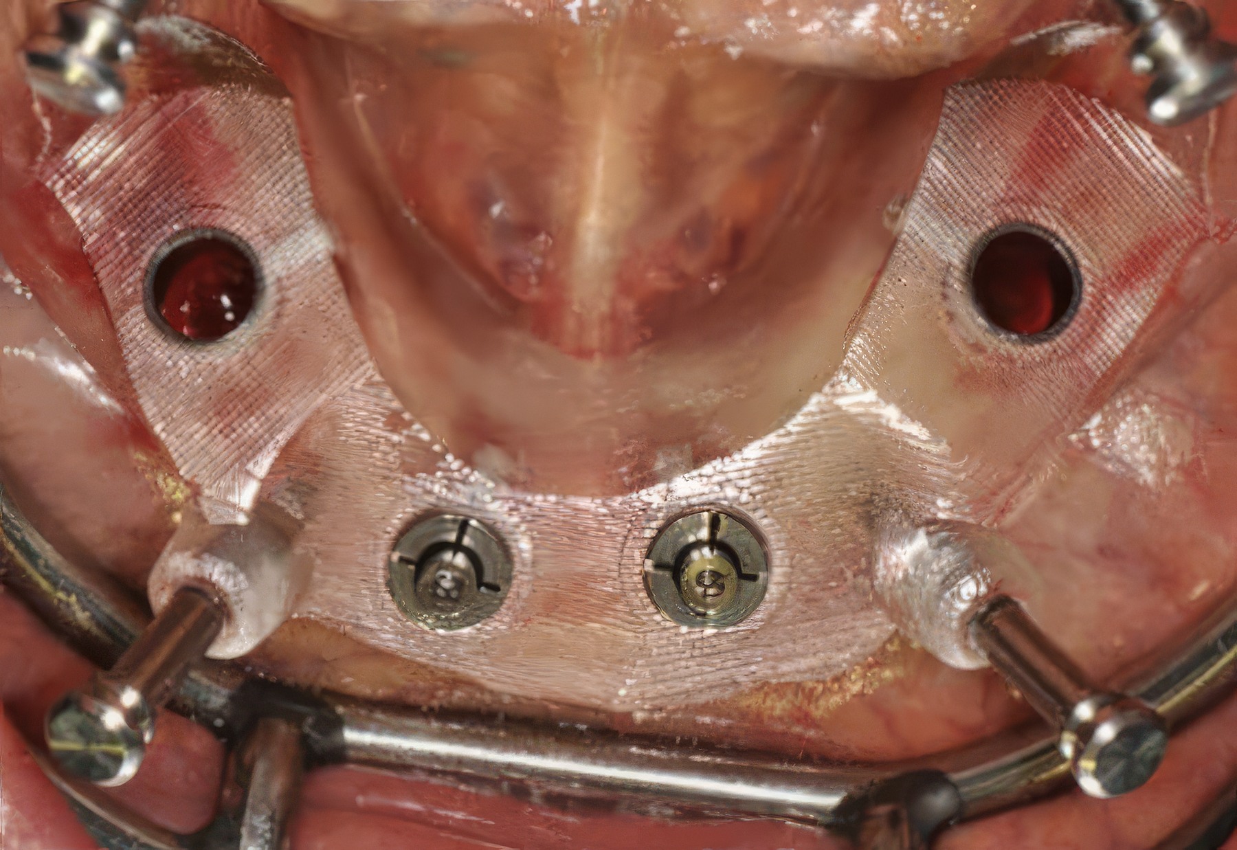 Step-By-Step Digital Workflow for Edentulous Implant Cases | Burbank Dental Lab