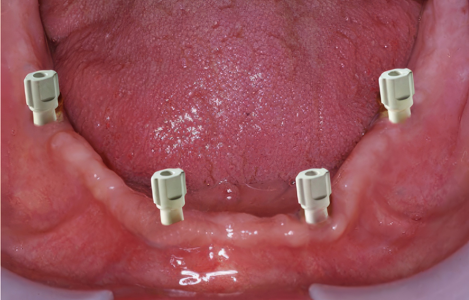 Step-By-Step Digital Workflow for Edentulous Implant Cases | Burbank Dental Lab