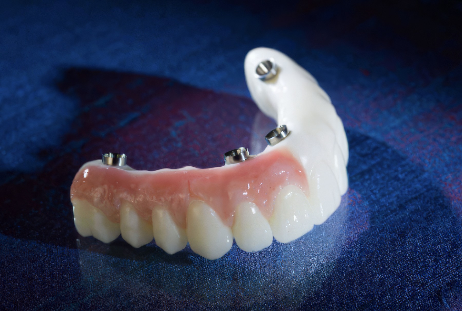 Step-By-Step Digital Workflow for Edentulous Implant Cases | Burbank Dental Lab