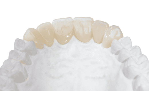 DuraTemp Provisional Restorations - Product - Burbank Dental Lab