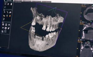 Edentulous Full-Arch Implant Treatment Planning: Evaluating Fixed vs Removable Options - Burbank Dental Lab