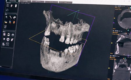 Edentulous Full-Arch Implant Treatment Planning: Evaluating Fixed vs Removable Options - Burbank Dental Lab