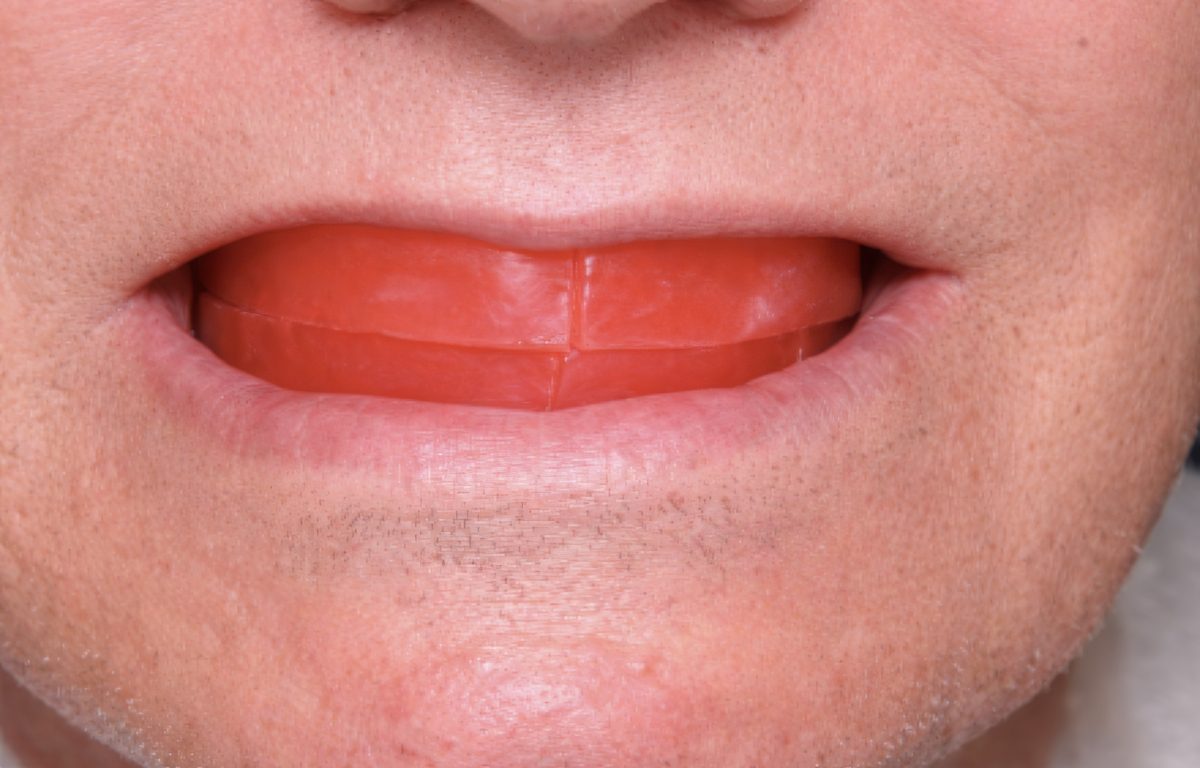 Edentulous Full-Arch Implant Treatment Planning: Evaluating Fixed vs Removable Options - Burbank Dental Lab