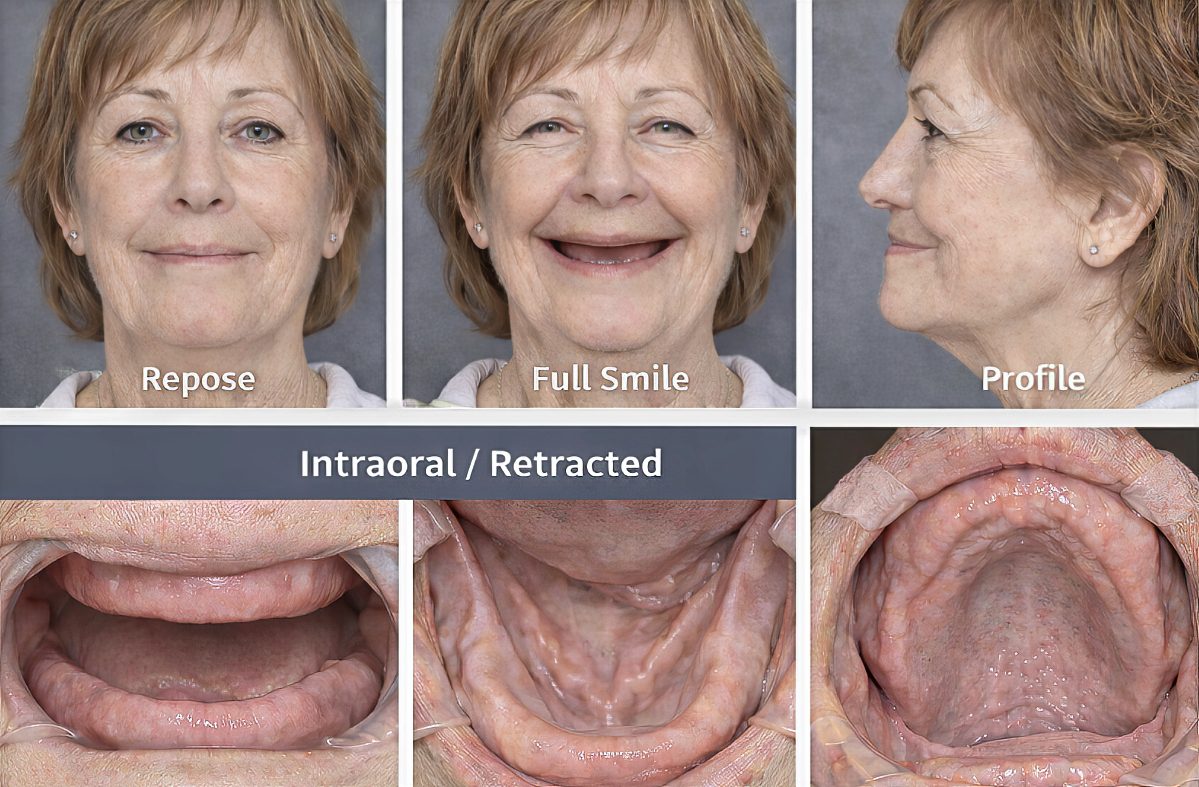 Edentulous Full-Arch Implant Treatment Planning: Evaluating Fixed vs Removable Options - Burbank Dental Lab