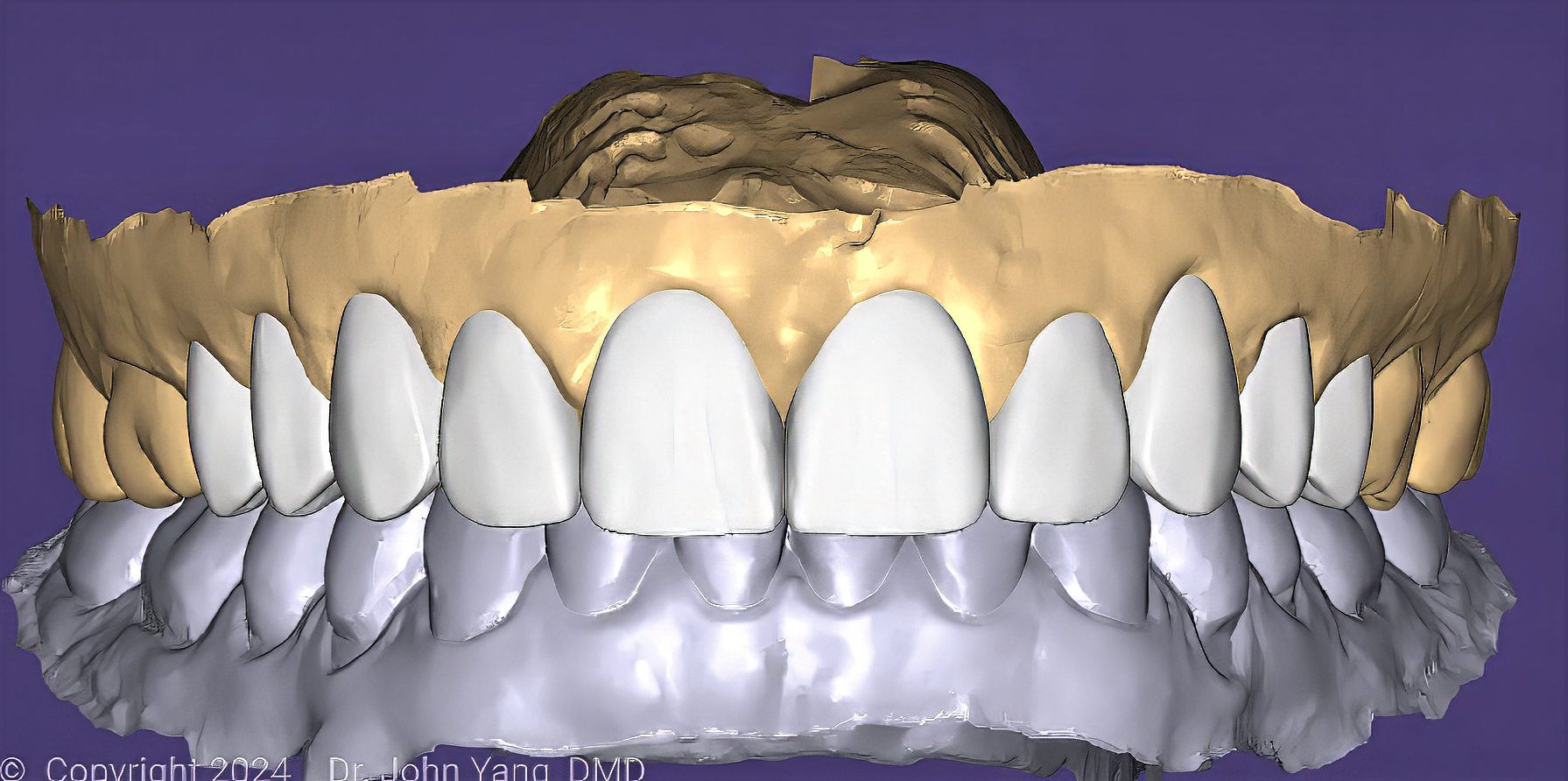 How to Begin a Full-Mouth Rehabilitation: A Case-Based Guide to Esthetics, Function, and Diagnostic Wax-Ups - by Andrew Sedler, COO with Dr. Mark Tyma, DMD