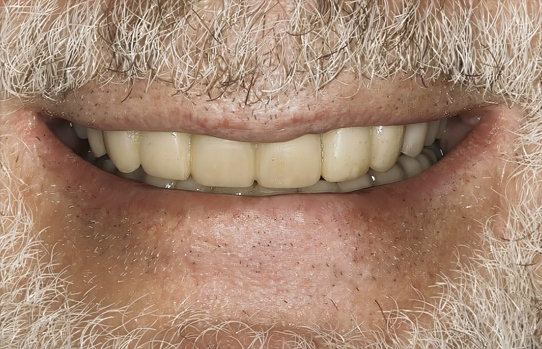 How to Begin a Full-Mouth Rehabilitation: A Case-Based Guide to Esthetics, Function, and Diagnostic Wax-Ups - by Andrew Sedler, COO with Dr. Mark Tyma, DMD