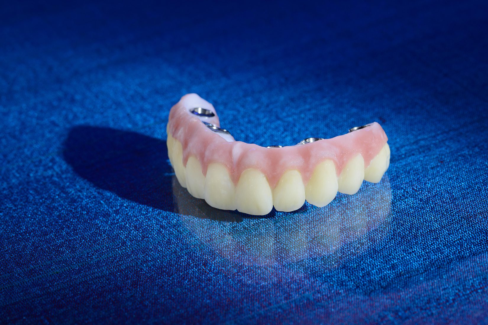 Hybrid Dentures Explained:  Restorative Materials, Framework Design, and Clinical Considerations for Full-Arch Implant Cases - Burbank Dental Lab - CA