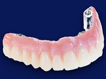 SMART 1 Implant Abutments - Burbank Dental Lab