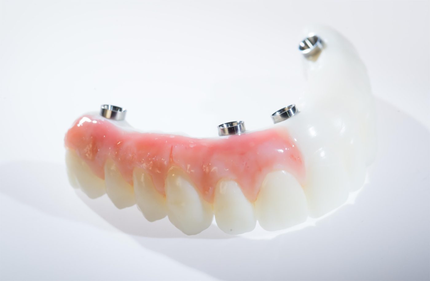 Denture Over Implant Bars - Burbank Dental Lab