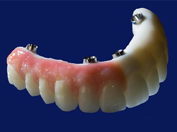 SMART 1 Implant Abutments - Burbank Dental Lab