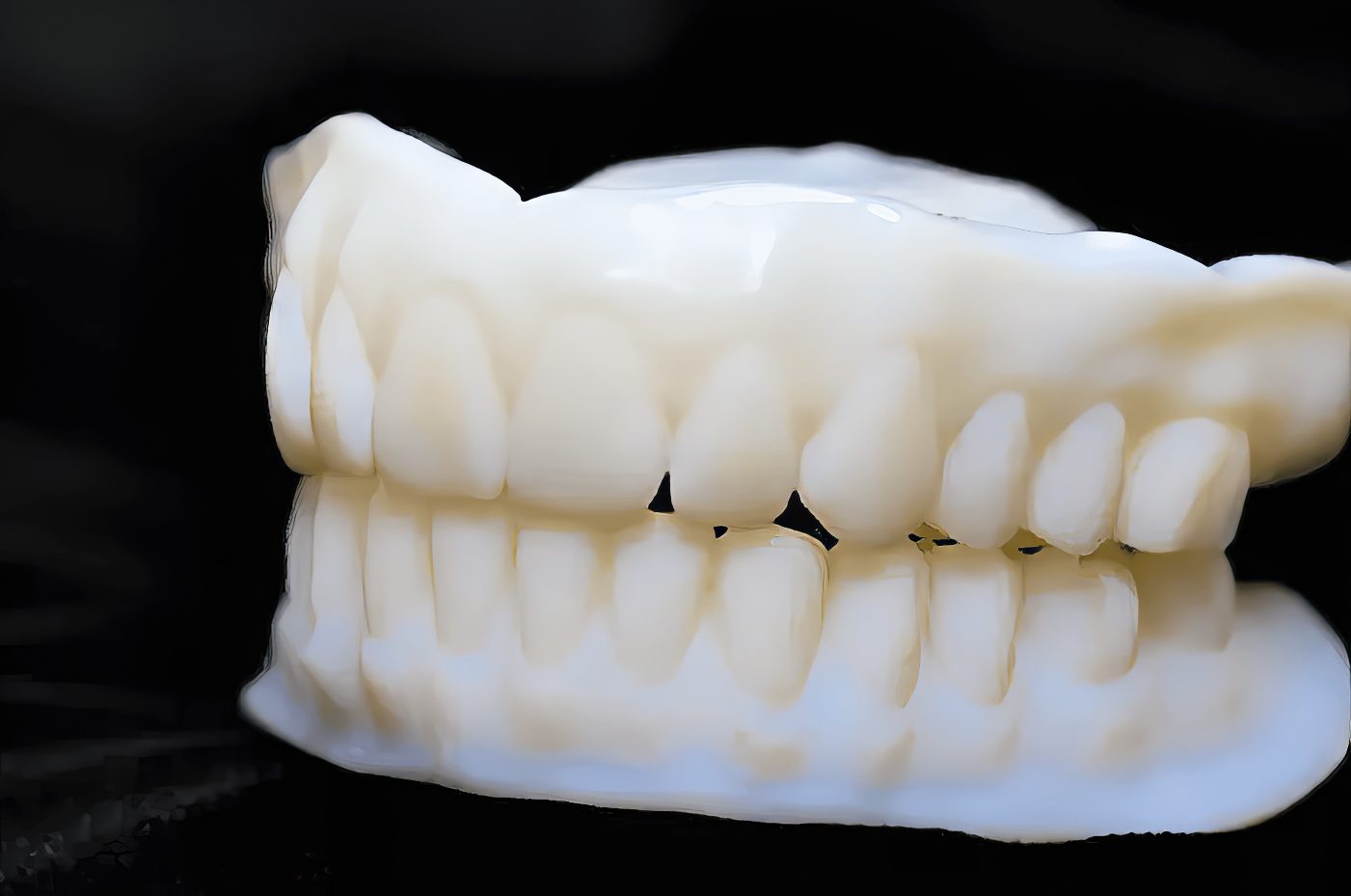 3D Bite Plate - Ivoclar Digital Bite Plates - Burbank Dental Lb