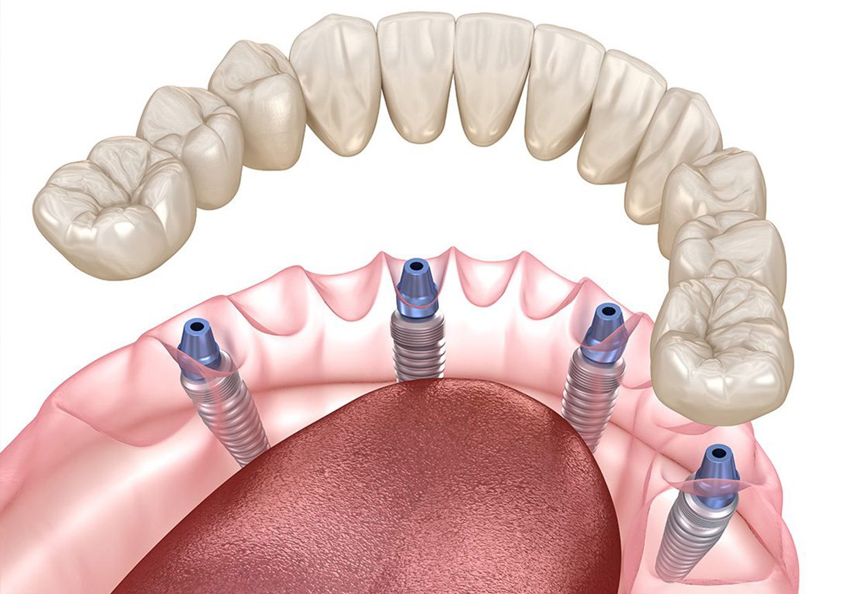 Mastering Full-Arch Implant Prosthodontics - Course - Advanced Technology Center - Sponsored by Burbank Dental Lab
