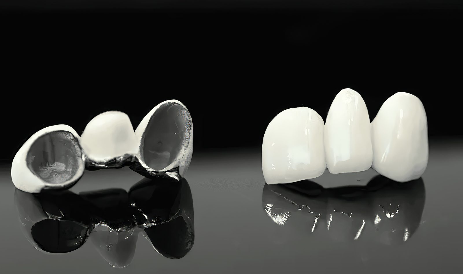Denture Over Implant Bars - Burbank Dental Lab