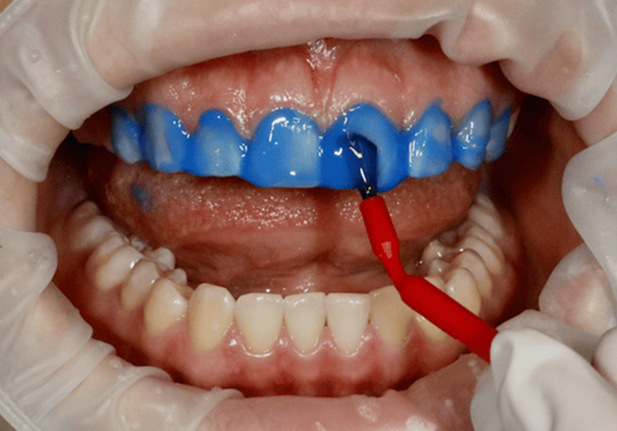 Webinar, January 21, 2026 - Learn The Porcelain Veneer Cementation Blueprint - Dr. Marvin Berlin