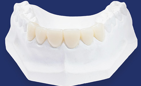 Provisional Restorations as Diagnostic Tools | Burbank Dental Lab