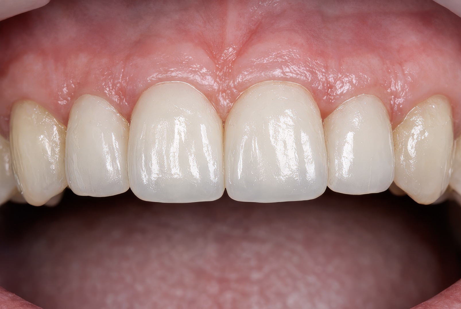 Provisional Restorations as Diagnostic Tools | by Andrew Sedler, COO  |   Burbank Dental Lab