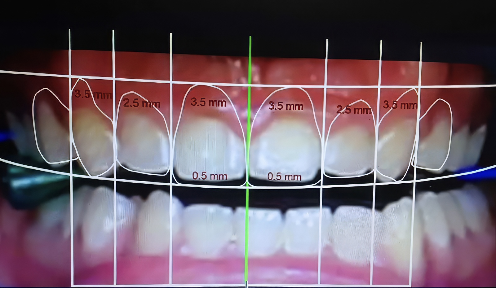 Provisional Restorations as Diagnostic Tools | by Andrew Sedler, COO  |   Burbank Dental Lab