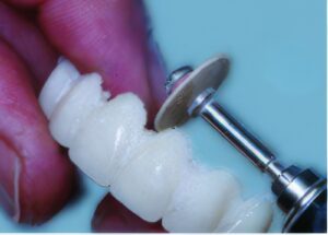 Provisional Restorations as Diagnostic Tools | Burbank Dental Lab