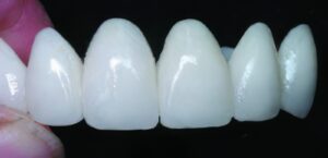 Provisional Restorations as Diagnostic Tools | Burbank Dental Lab