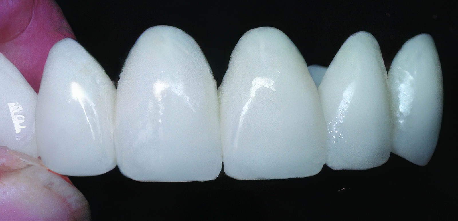 Provisional Restorations as Diagnostic Tools | Burbank Dental Lab
