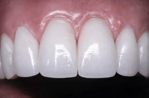Provisional Restorations as Diagnostic Tools | Burbank Dental Lab