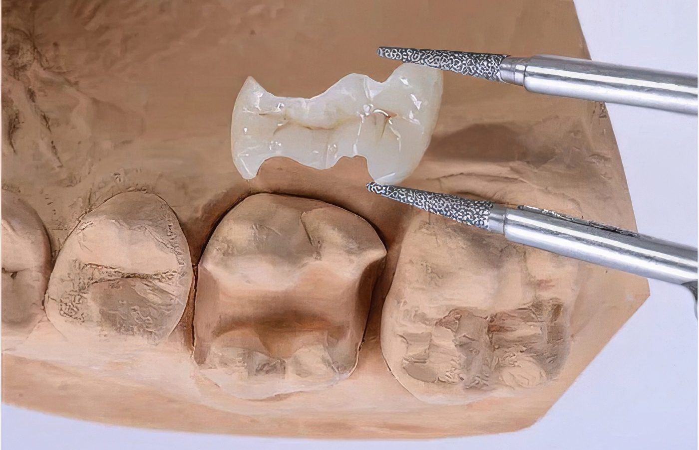 Ceramage Composite by SHOFU - Burbank Dental Lab