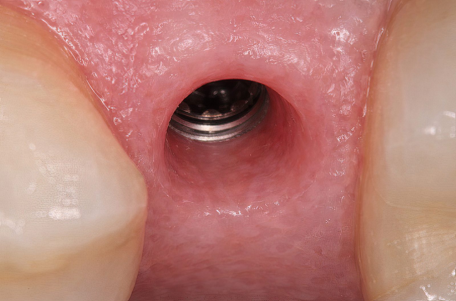 Ivoclar Digital Denture Workflow: A Dentist Focused Guide - Burbank Dental Lab - CA