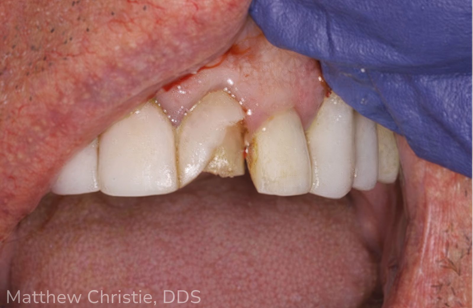Single Central Restorations: Why Complete Case Information Is the Deciding Factor - Burbank Dental Lab - CA